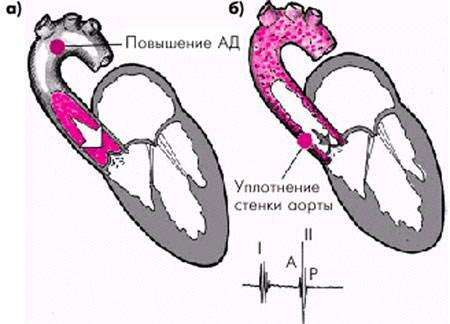 Уплотнение корня аорты и створок аортального клапана