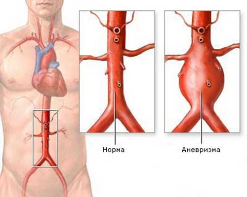 аневризма аорты