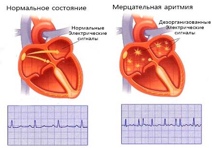 аритмия сердца