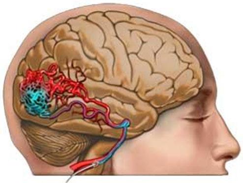 сосудистая мальфомация в головном мозге