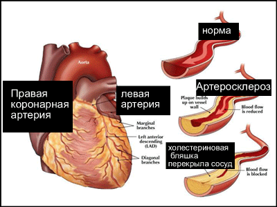 Атеросклеротический кардиосклероз