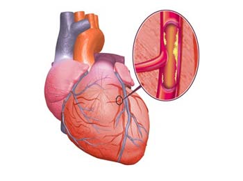 атеросклероз сердца