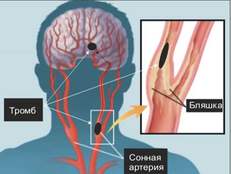Атеросклероз головного мозга лечение и сонные артерии thumbnail