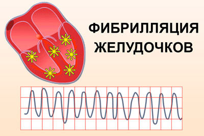 фибрилляция желудочков сердца