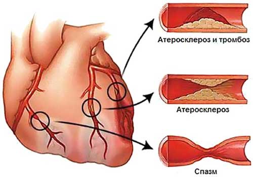 формирование тромбов в сердце