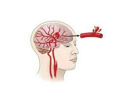 разрыв артерии в головном мозге