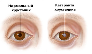катаракта