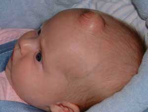 киста мозга у новорождённого