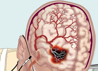 ишемия головного мозга