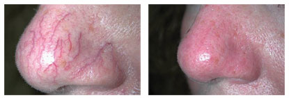 Сосудистая сетка на носу причины симптом какой болезни thumbnail