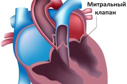 Как болит сердце при пролапсе митрального клапана thumbnail