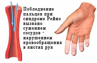 нарушение кровоснабжения рук
