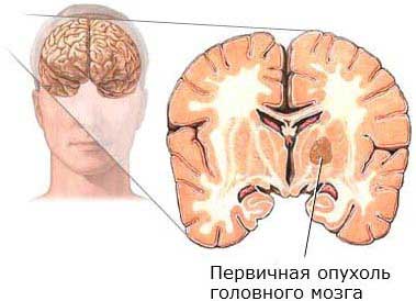 опухоль в мозге