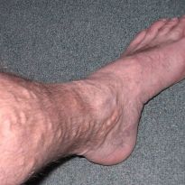У мужчины на ногах выступают вены лечение thumbnail