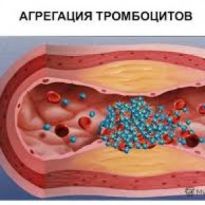 Гипоагрегация тромбоцитов