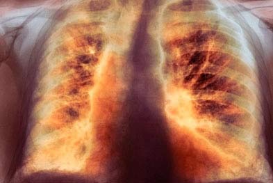 поражение лёгких