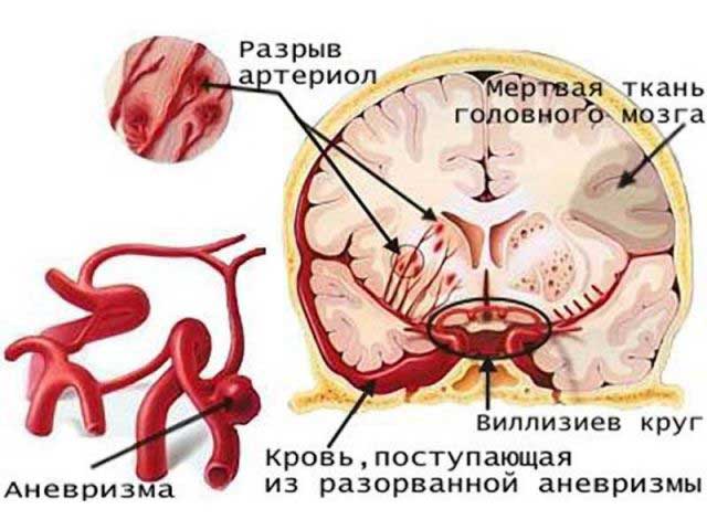 последствия кровоизлияния в мозг