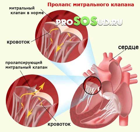 Пролапс митрального клапана инфаркт миокарда thumbnail