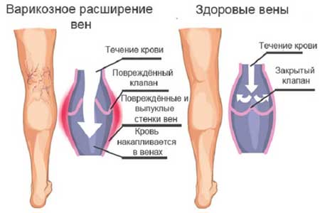 Вздутые вены на ногах у мужчин лечение thumbnail