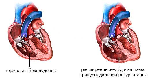 расширенный желудочек сердца