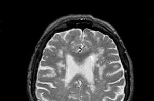 Лейкопатия головного мозга у ребенка