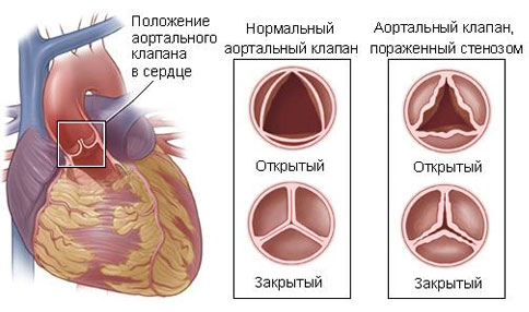 стеноз аортального клапана