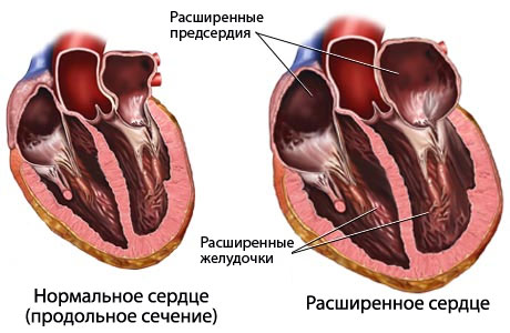 увеличенные желудочки сердца