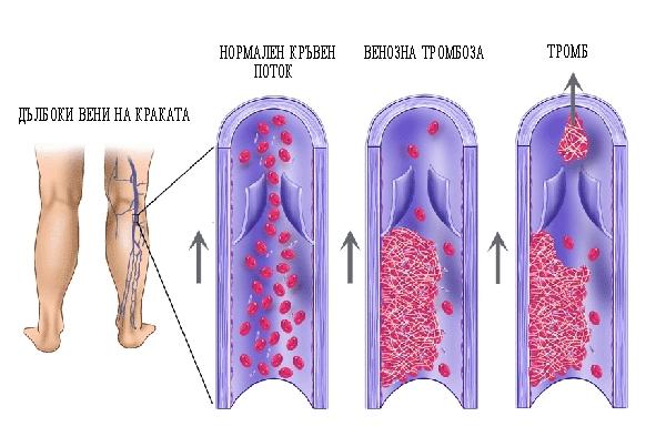 развитие тромбоза