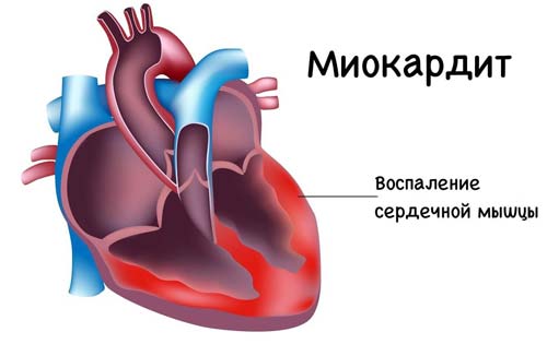 воспаление сердечной мышцы
