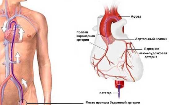 введение катетера в артерию бедра