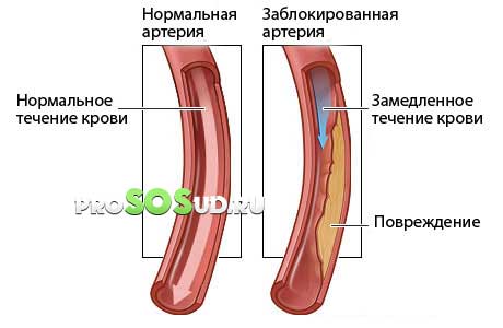 плохой ток крови в артерии